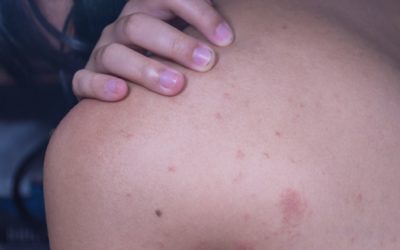 Eczema & CBD